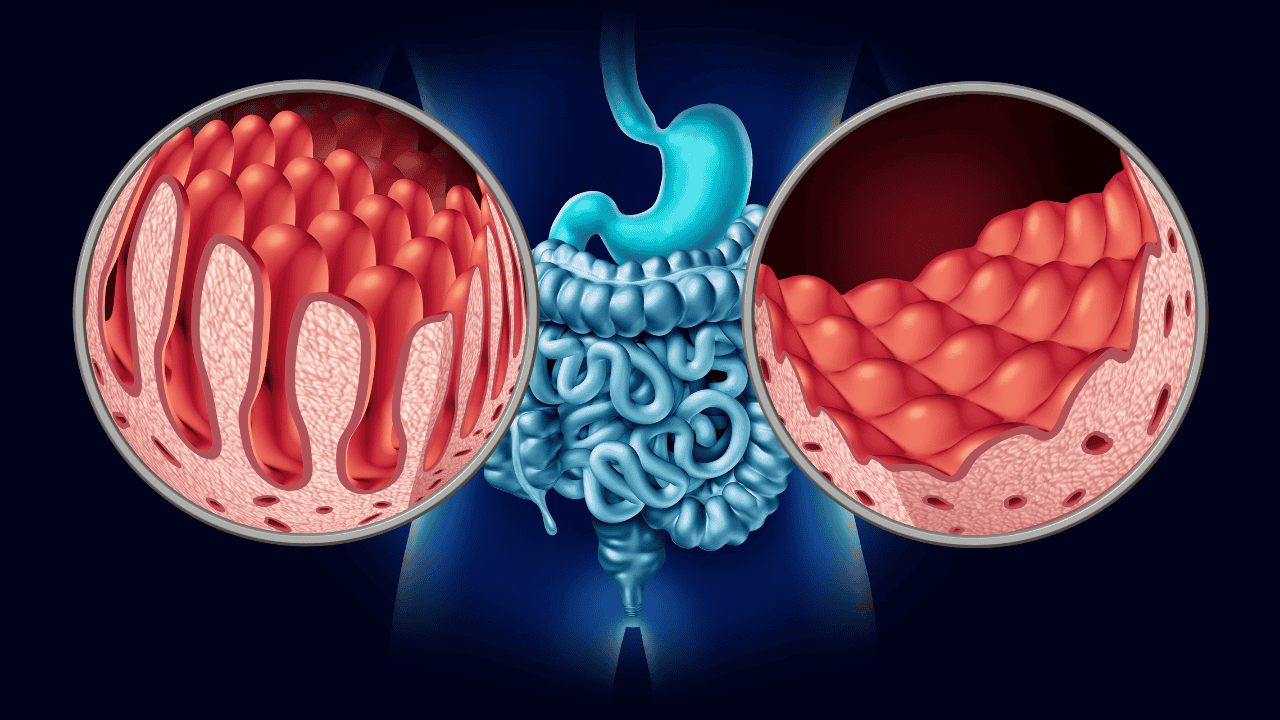 Celiac Disease vs. Gluten Sensitivity: Do You Really Need to Go Gluten-Free?