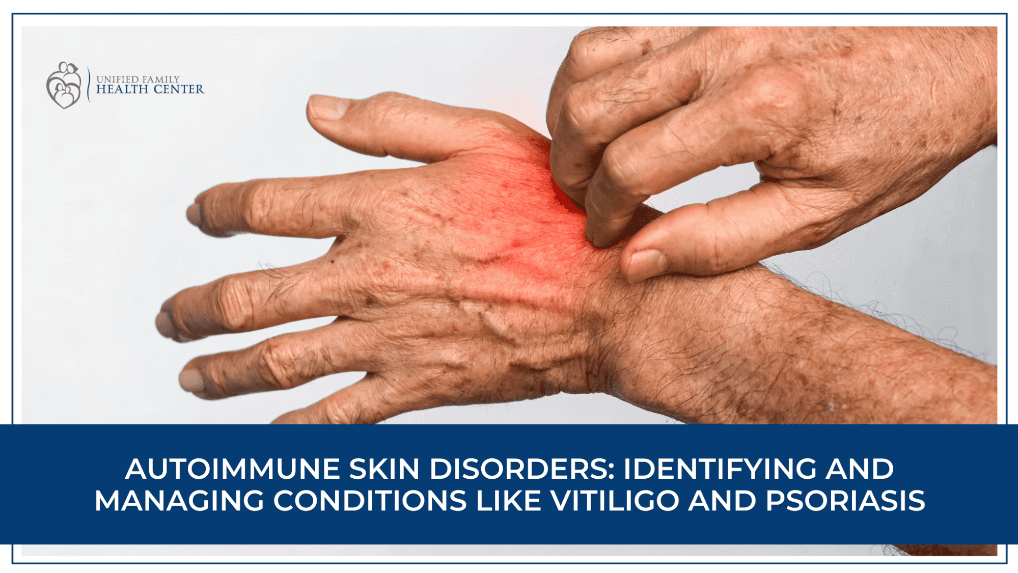 Autoimmune Skin Disorders: Identifying and Managing Conditions Like Vitiligo and Psoriasis